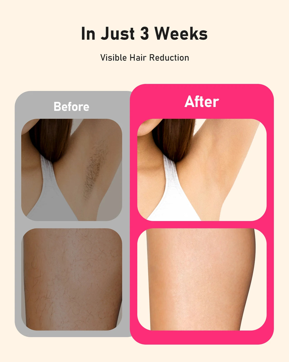 JOOYEE IPL Laser Hair Removal Device For Efficient Daily Use